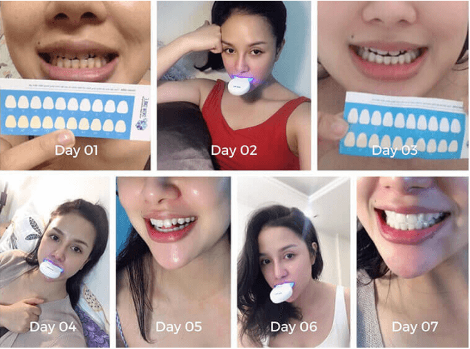 hiệu quả của máy ngậm trắng răng snow smile sau 7 ngày sử dụng