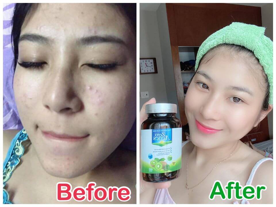 chung tuệ nghi review zero acnes